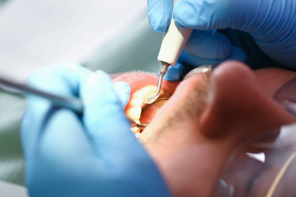 Best Emergency Tooth Extraction in Palmdale, CA