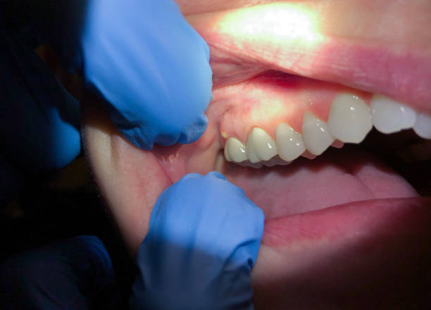 Best Emergency Treatment for Toothache in Palmdale, CA