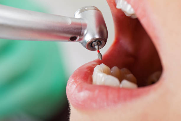 Best Emergency Wisdom Teeth Removal in Palmdale, CA